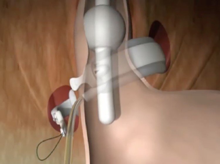 Il bendaggio gastrico regolabile