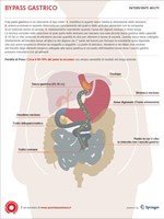 Bypass gastrico funzionale