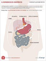 Il bendaggio gastrico regolabile