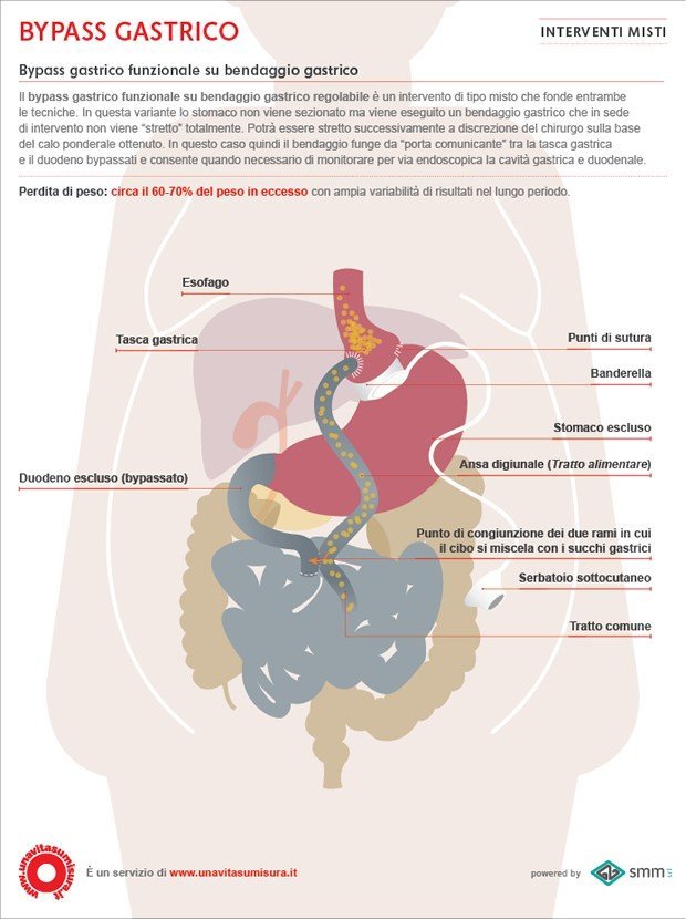 Bypass gastrico funzionale su bendaggio gastrico