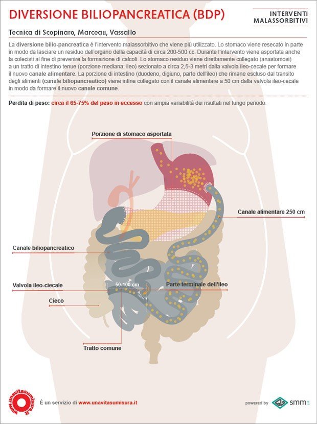 Diversione biliopancreatica (BDP) – Tecnica di Scopinaro, Marceau, Vassallo