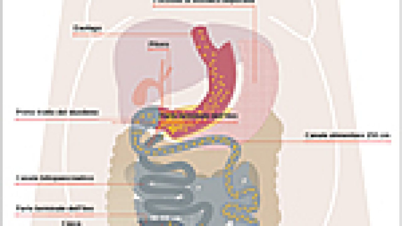 Diversione biliopancreatica con Duodenal Switch