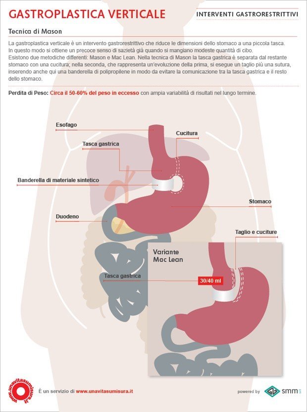 Gastroplastica verticale (Sleeve gastrectomy o Sleeve) – Tecnica di Mason