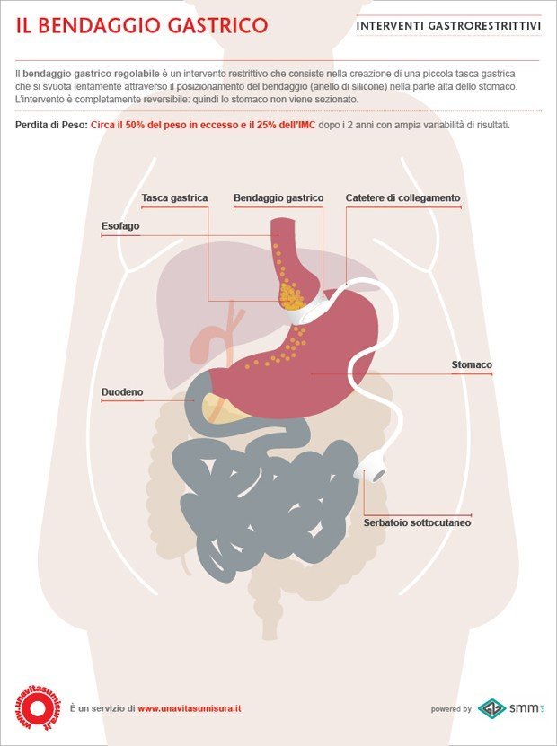 Il bendaggio gastrico