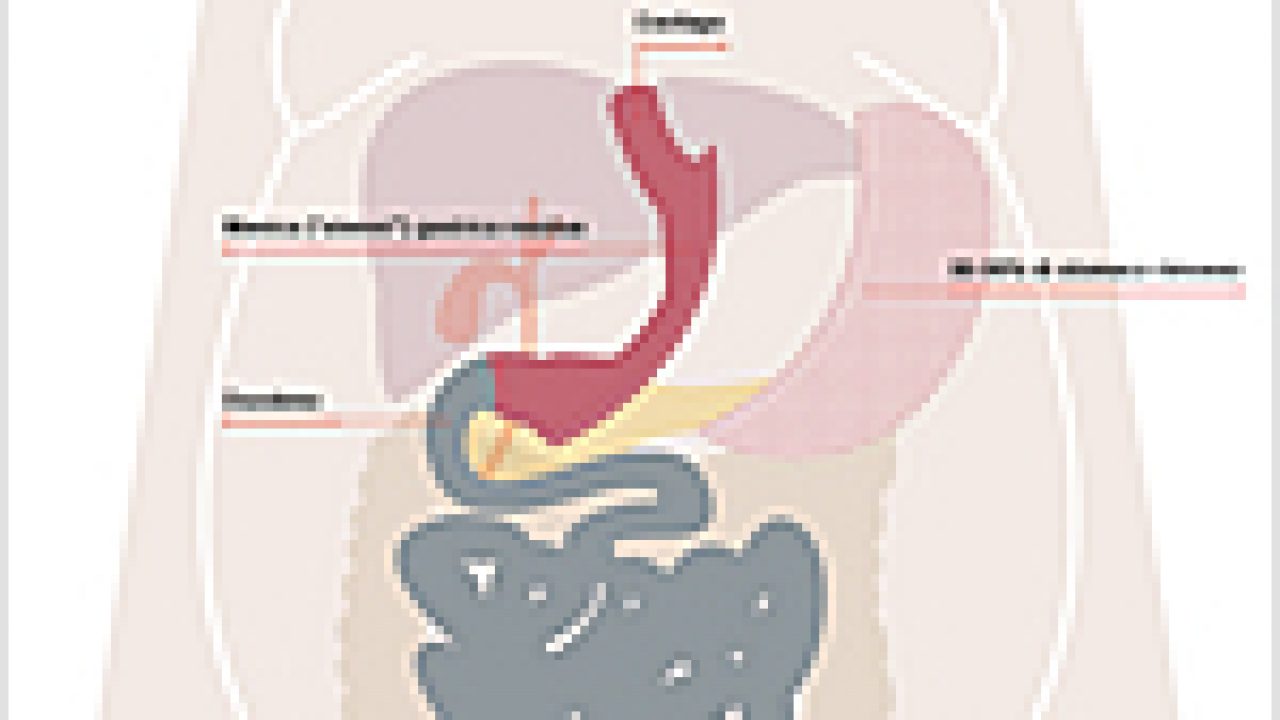 Sleeve gastrectomy – Gastrectomia verticale parziale
