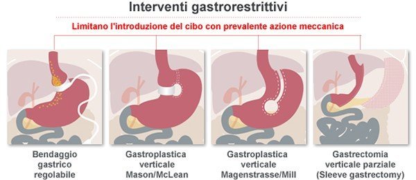 Uno studio americano rassicura sugli esiti della chirurgia bariatrica