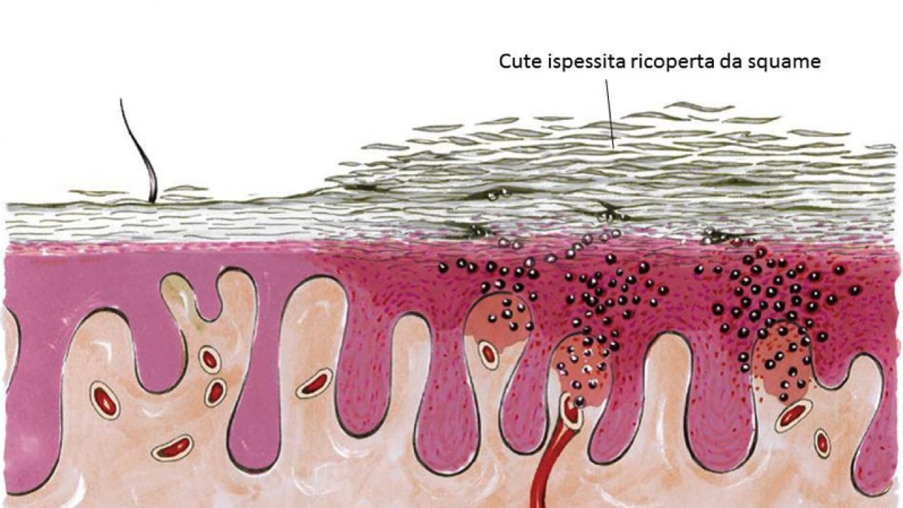 Che cosa succede alla pelle in corso di psoriasi?
