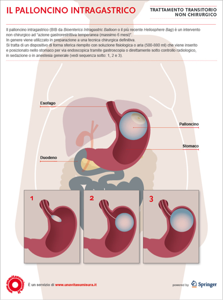 palloncino intragastrico (BIB)