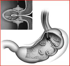 Endoscopia bariatrica