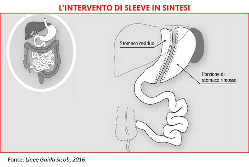 Intervento sleeve gastrectomy