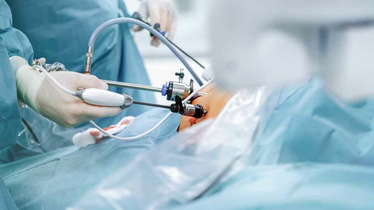 La sleeve gastrectomy: a chi è consigliata? Vantaggi, svantaggi, rischi e complicanze