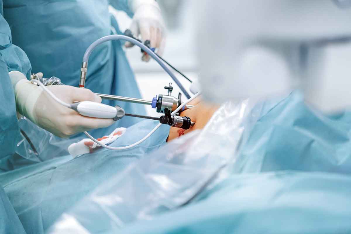 La sleeve gastrectomy: a chi è consigliata? Vantaggi, svantaggi, rischi e complicanze